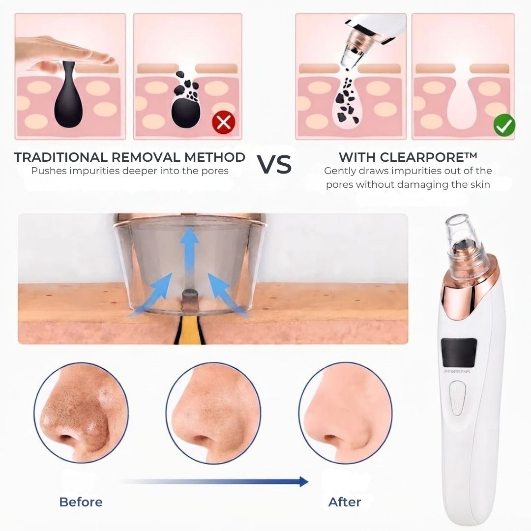 ClearPore™ - Cordless Blackhead & Pore Cleaner