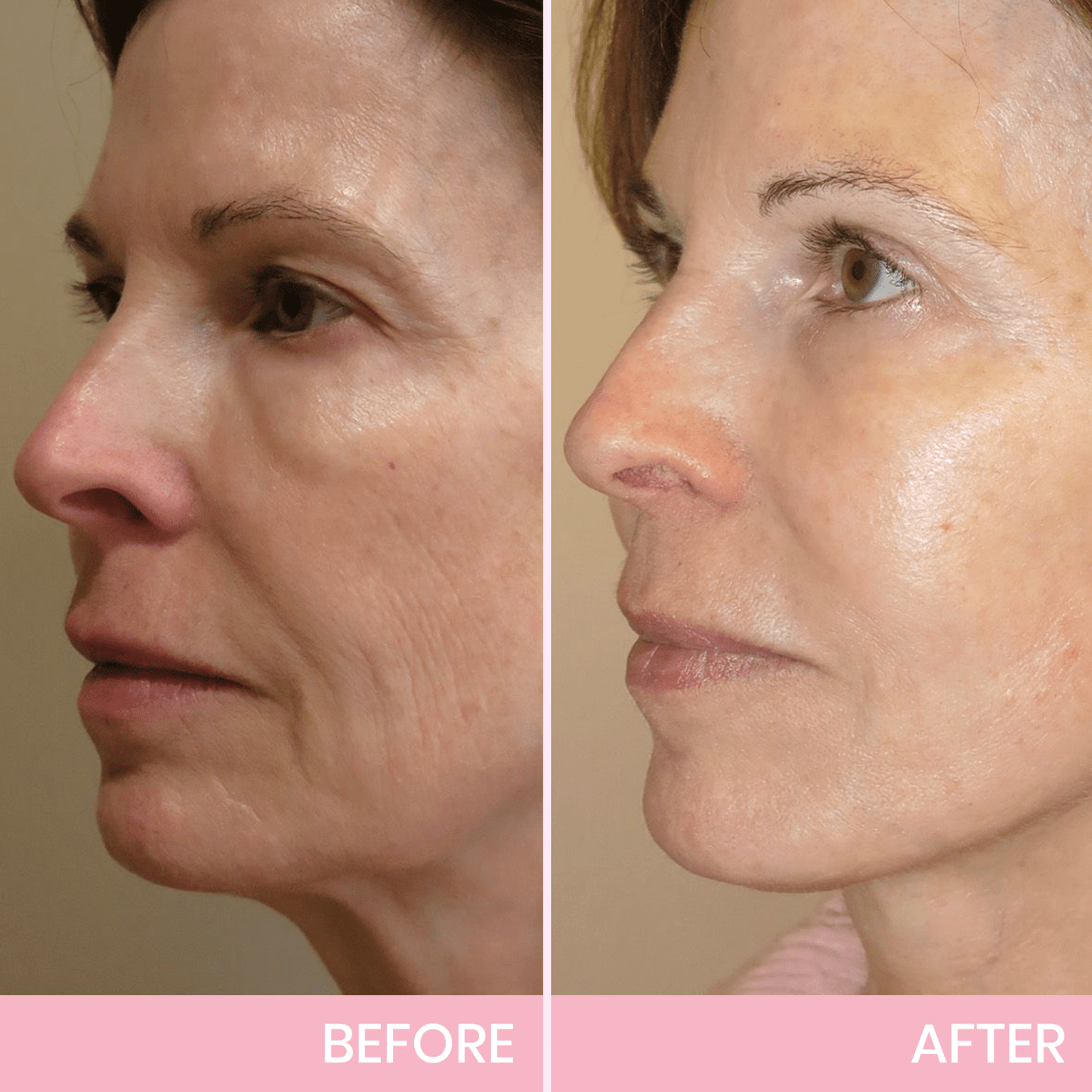 Invisible V-Line Face Lifting Tape