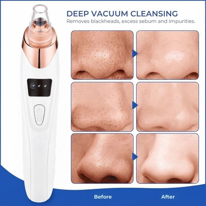 ClearPore™ - Cordless Blackhead & Pore Cleaner